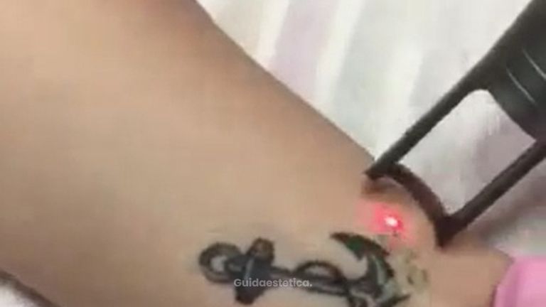 Rimozione tatuaggi