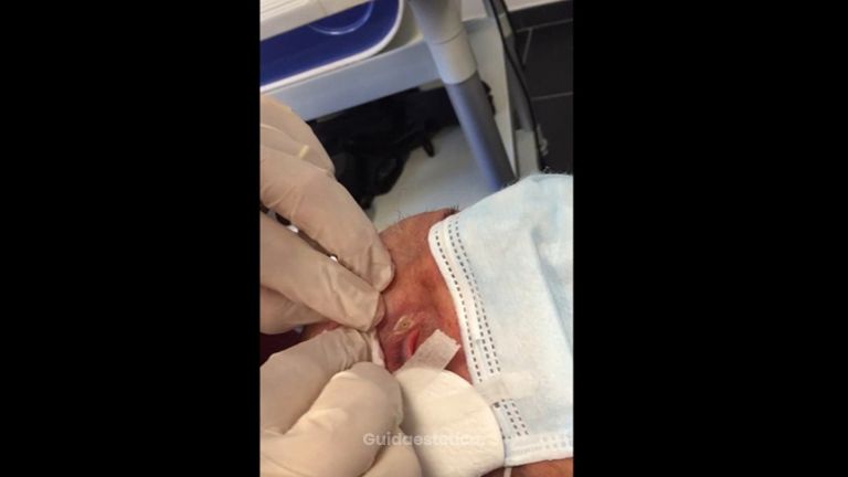 Verruche - Dott. Virgilio Medical Laser