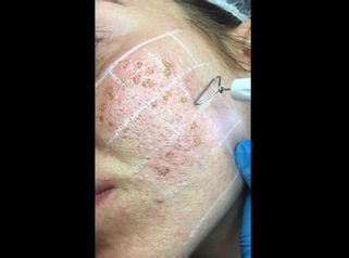 Plexer con puntale bio tips per trattamento cicatrici da acne