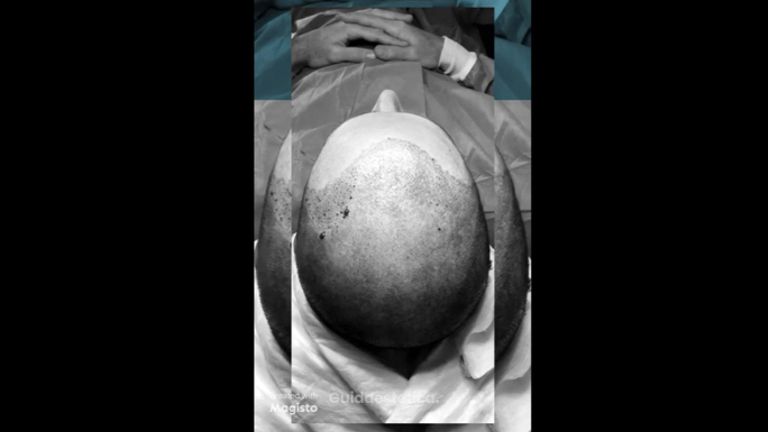 Trapianto capelli - Nonsolobisturi