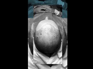 Trapianto capelli - Nonsolobisturi