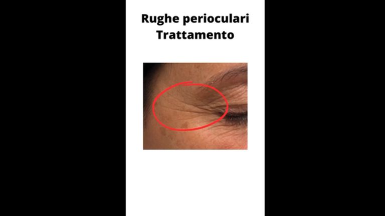 Rughe perioculari trattamento con botulino - Dott. Giovanni Migliorini
