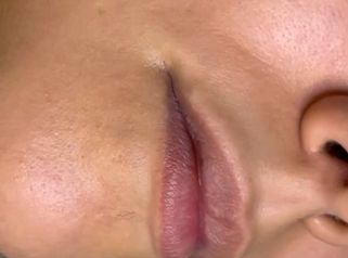 Filler labbra Dottor Mario Marano