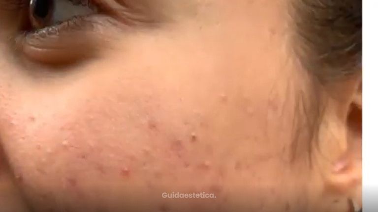 Dott.ssa Graham: Video esperienza acne