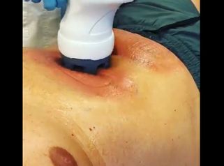 Criolipolisi - Dott.ssa Giulia Bianchi