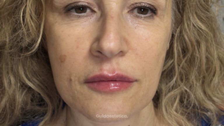 filler labbra
