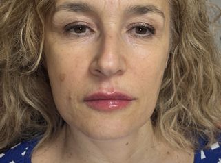 filler labbra