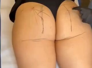 PPM Medical Rimodellamento Glutei Non Chirurgico con Filler