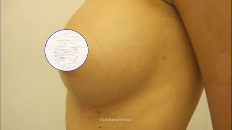 Dott. Delli Santi: Mastoplastica additiva