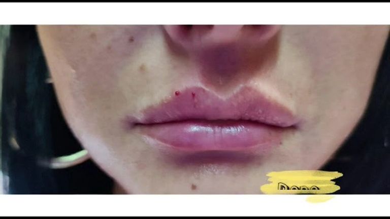 Trattamento labbra e solco naso- labiale - Dott. Maurizio Santoro