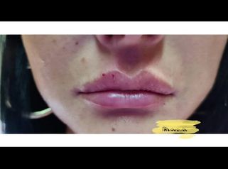 Trattamento labbra e solco naso- labiale - Dott. Maurizio Santoro