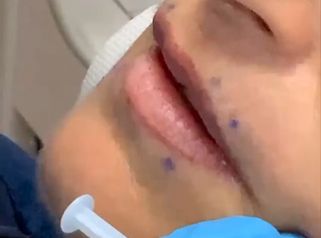 Filler - Studio Medico Adigrat