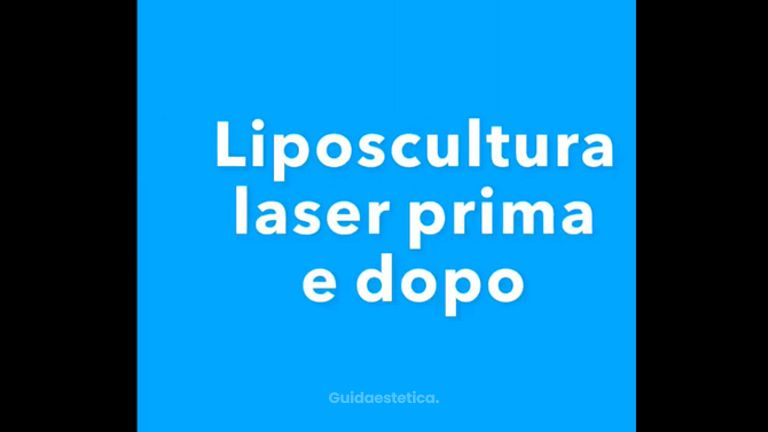 Liposcultura - Dott. Giovanni Gallo