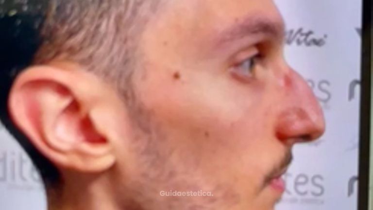 Dott. Matteo Tutino Rinoplastica: il racconto di Vincenzo 3 anni dopo