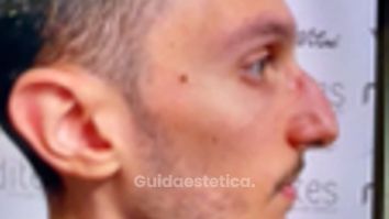 Dott. Matteo Tutino Rinoplastica: il racconto di Vincenzo 3 anni dopo