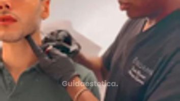 Venini Ventitre Medical Center Filler mandibolare uomo per definire l’ovale del viso