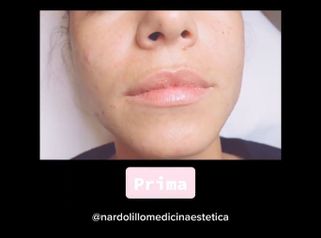 Filler labbra - Dott.ssa Paola Nardolillo