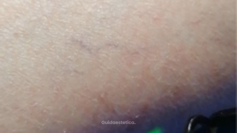 Laserterapia - Dott. Umberto Fama