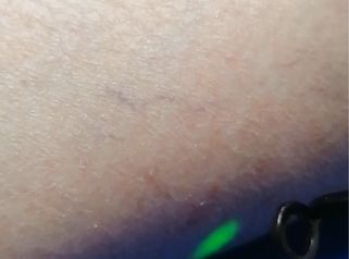 Laserterapia - Dott. Umberto Fama