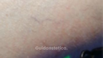 Laserterapia - Dott. Umberto Fama