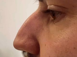 Dott. Benoit Menye Rinofiller uomo: correzione della gobba e della punta del naso senza chirurgia