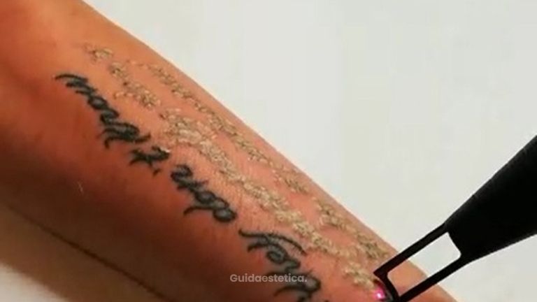 Rimozione tattoo