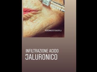 Medicina Estetica Cotilli: Acido ialuronico