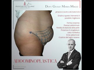 Addominoplastica - Aesthetic Clinic del Dott. Giulio Maria Maggi