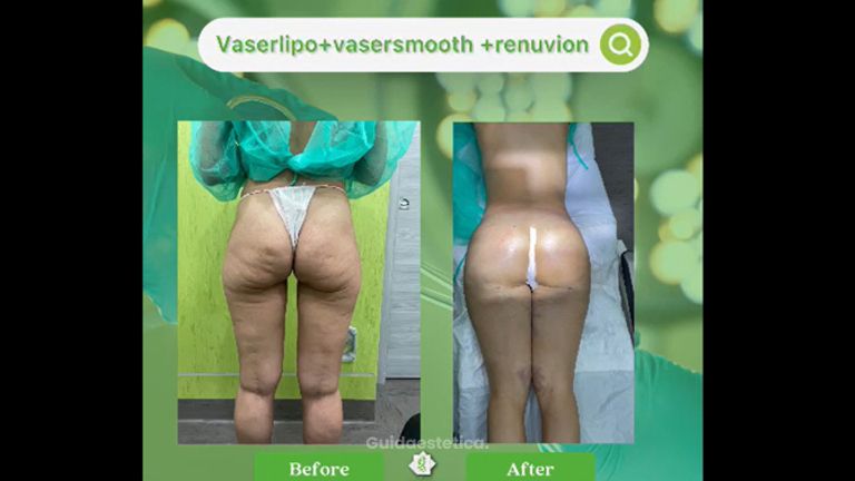 Liposuzione - Dott. Umberto Tozzi - Clinique Visage