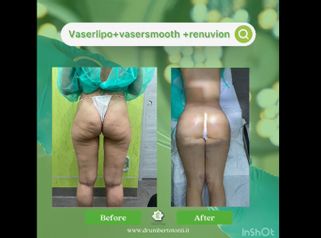 Liposuzione - Dott. Umberto Tozzi - Clinique Visage