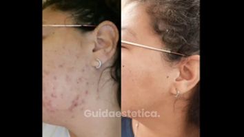 Acne - Tuamedica