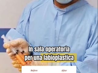 In sala operatoria labioplastica e lipofilling