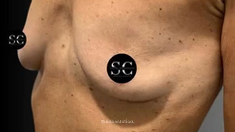 Dr. Stefano Chiummariello Mastoplastica additiva prima e dopo: trasformazione reale