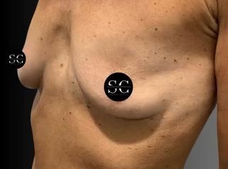 Dr. Stefano Chiummariello Mastoplastica additiva prima e dopo: trasformazione reale