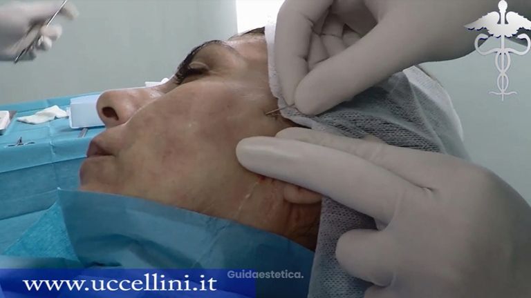 Fili riassorbibili di sospensione e biostimolazione