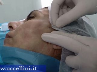 Fili riassorbibili di sospensione e biostimolazione