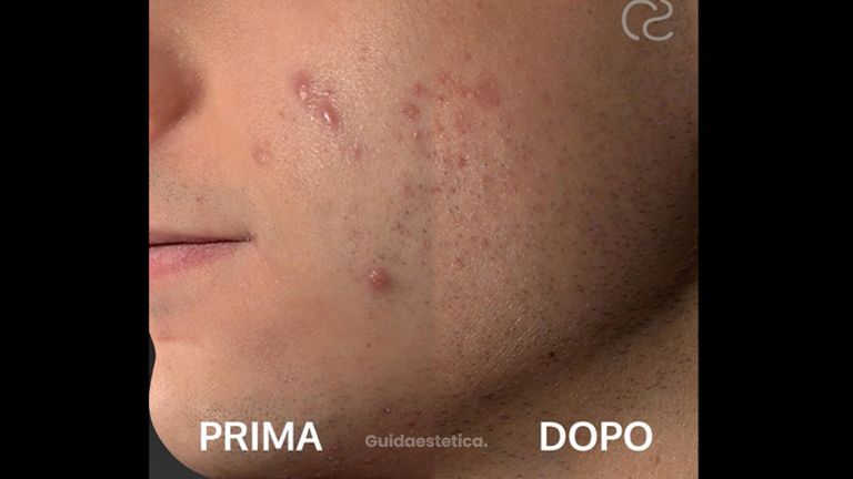 Acne