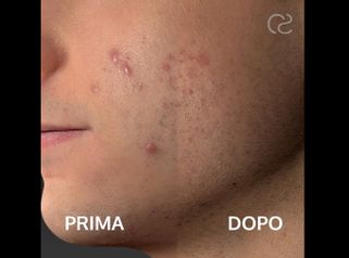 Acne