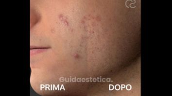 Acne