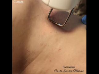 Depilazione laser - Dott.ssa Carla Enrica Marino