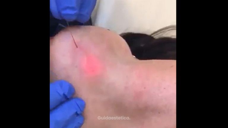 Liposuzione - Dott. Riccardo Accordi