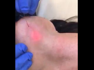 Liposuzione - Dott. Riccardo Accordi