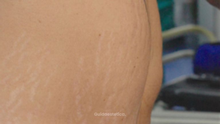 Dott. Arturo Amoroso Addominoplastica con resezione a 360° e chiusura centrale