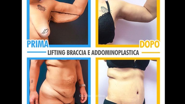 Lifting braccia e addominoplastica