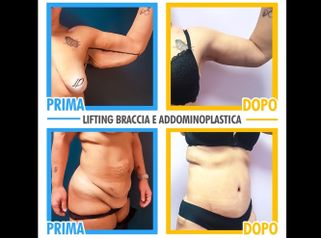 Lifting braccia e addominoplastica