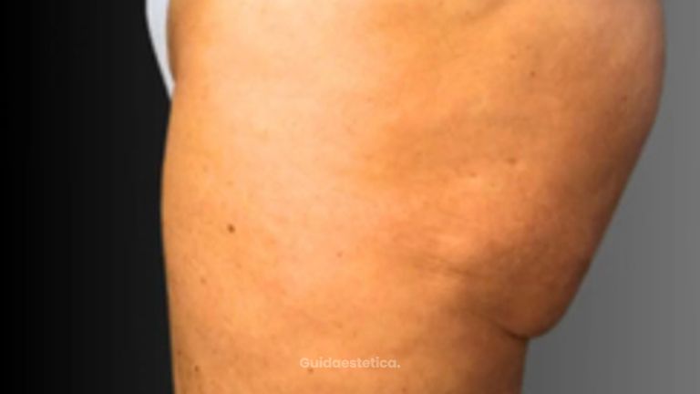 Lifting glutei - Dott. Fioravante Orefice