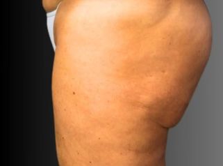 Lifting glutei - Dott. Fioravante Orefice