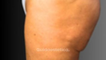 Lifting glutei - Dott. Fioravante Orefice