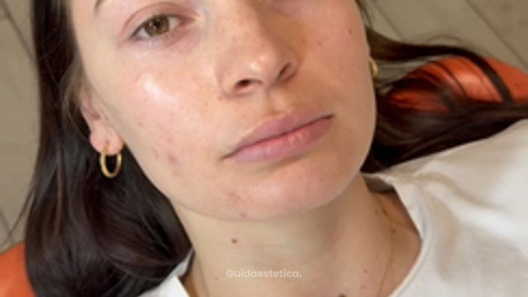 Dott.ssa Sara Carinci Volume naturale e proporzione: risultato filler labbra