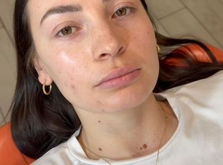 Dott.ssa Sara Carinci Volume naturale e proporzione: risultato filler labbra
